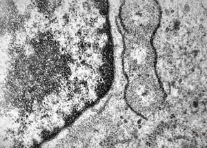 M,33y. | blood - hairy cell leukemia- ribosome-lamella complexin tricholeukocyte